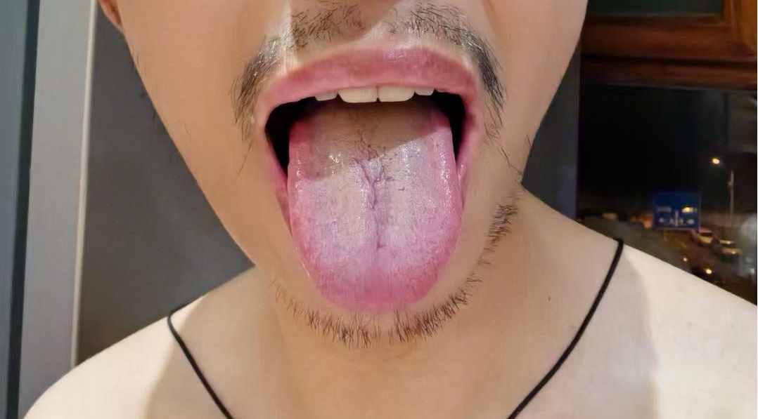 Tongue coating diagnosis