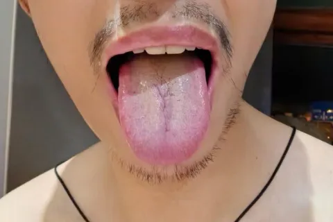 舌苔诊断案例1