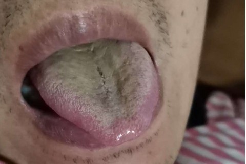 中医治愈新冠肺炎患者