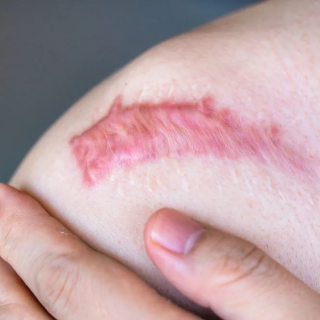 瘢痕疙瘩的中医治疗