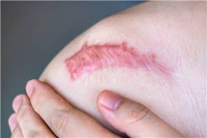 瘢痕疙瘩的中医治疗