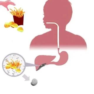 胆结石的中医治疗