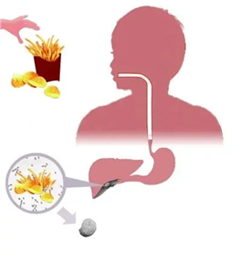 胆结石的中医治疗