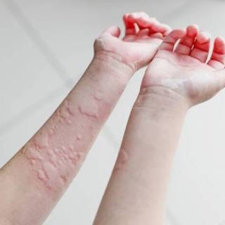 中医治疗荨麻疹、湿疹、皮疹、干苔