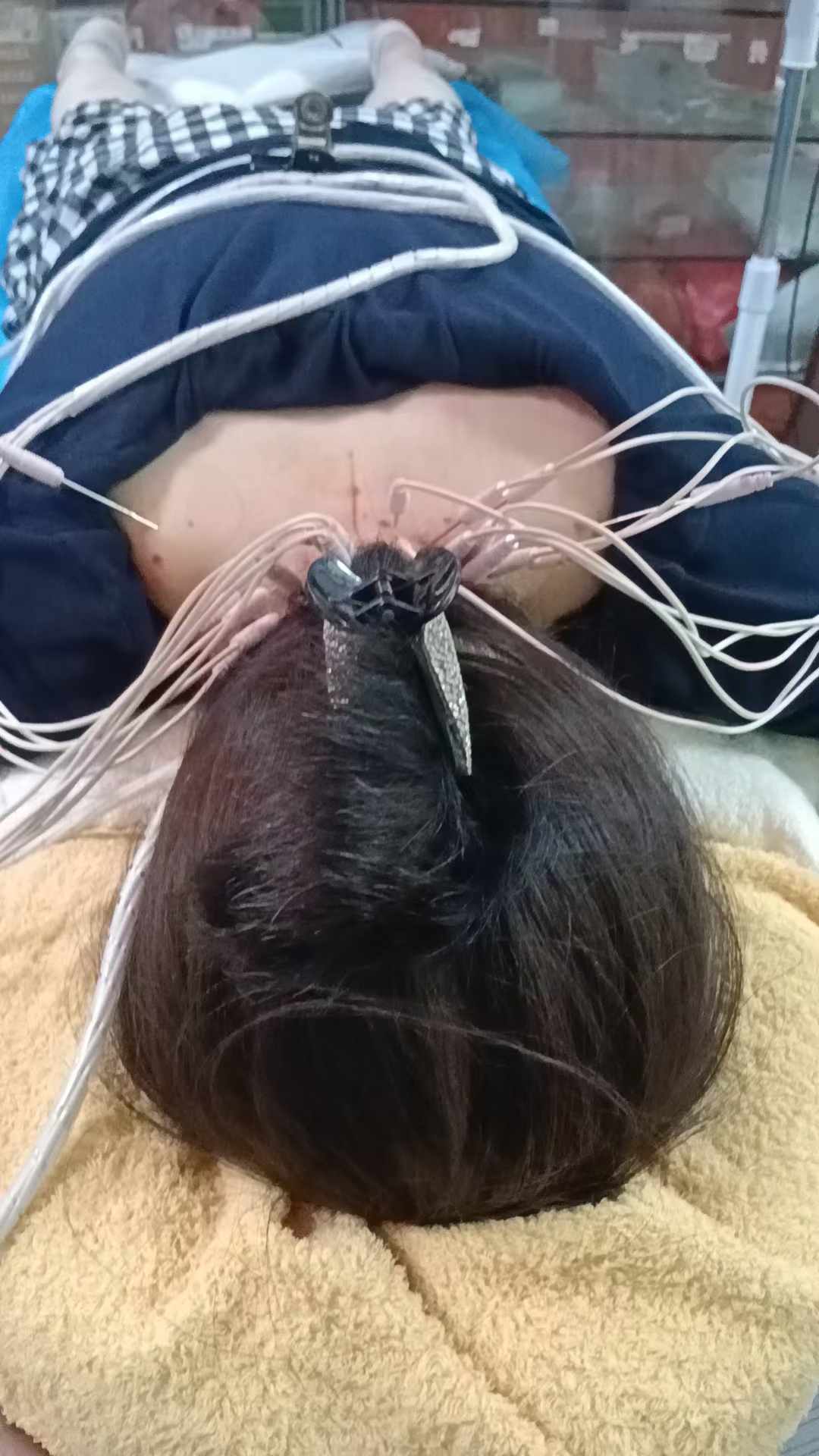 Cervical spondylosis and cerebellar infarction internal heat acupuncture combined with traditional Chinese medicine treatment