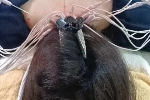 颈椎病、小脑梗死内热针灸配合中药治疗