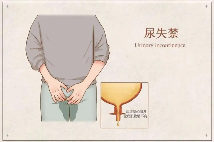 Urinary incontinence