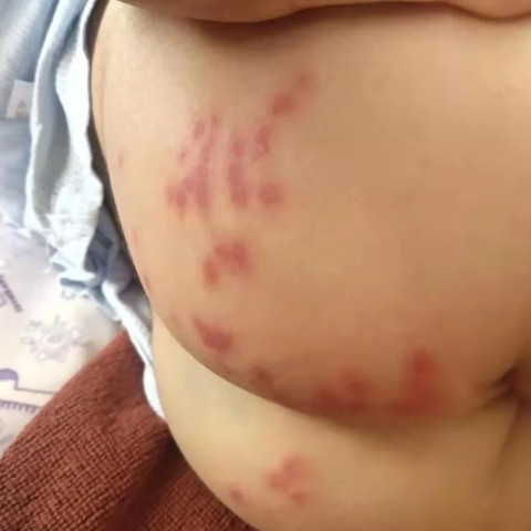 小儿麻疹中医治疗