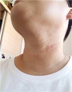 external powder for prickly heat