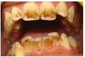teeth whitening powder