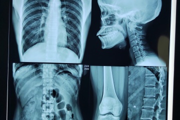 فيلم حراري جاف طبي متطور يُحدث ثورة في التصوير التشخيصي: ابتكارات جديدة تُعزز الدقة والكفاءة في الرعاية الصحية