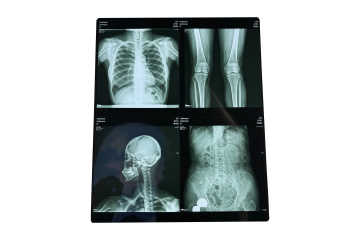 Medical Film Team Exceeds Target by 30%, Powered by medical thermal dry image film, inkjet film, medical laser film, x-ray film