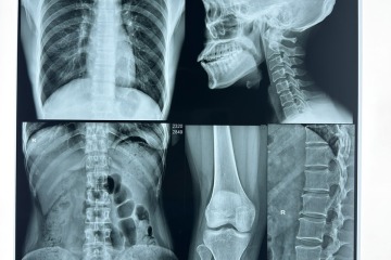 Película térmica médica de la marca HYC: Imágenes de precisión para cada detalle.