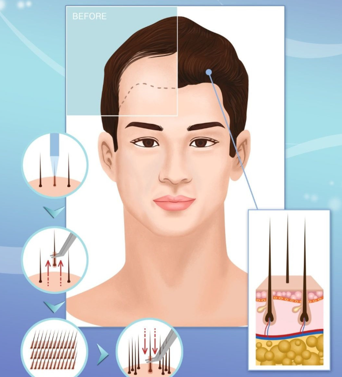Personalized hair transplant aesthetic system