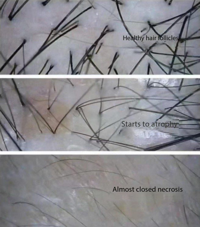 Comprehensive Analysis of Hair Follicle Testing