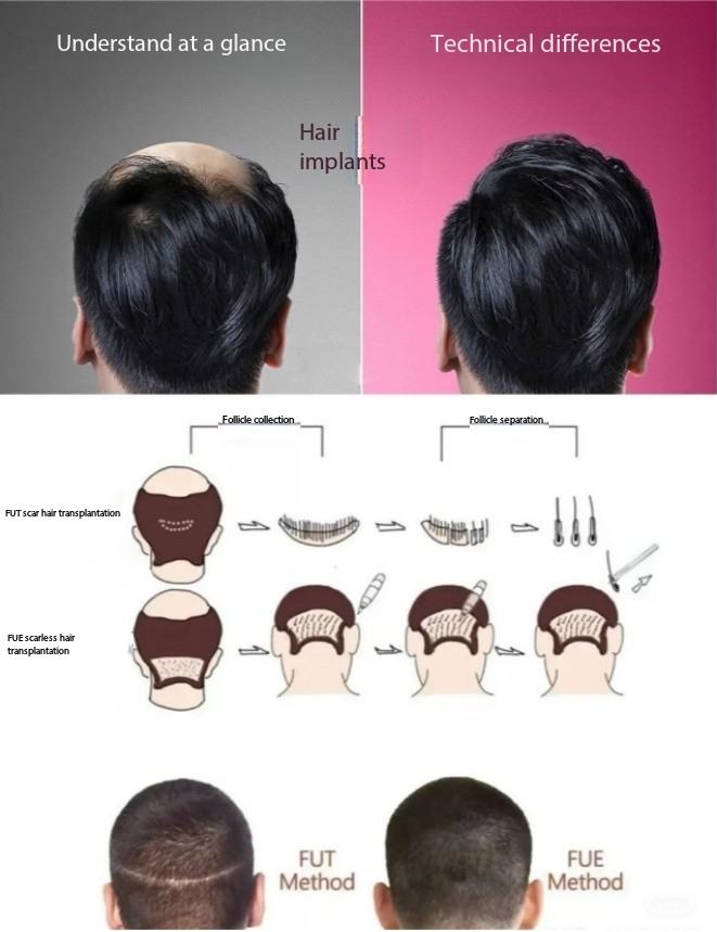 Hair Transplant Evolution