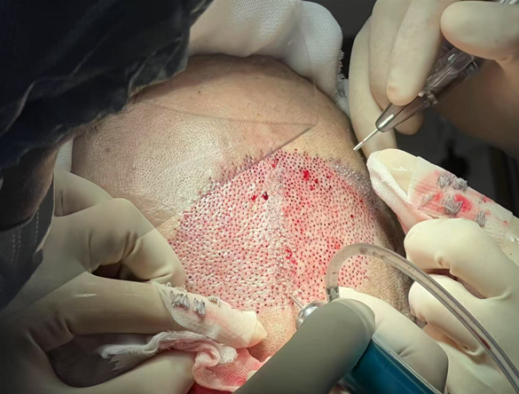 Technological Breakthroughs in Hair Transplant Devices