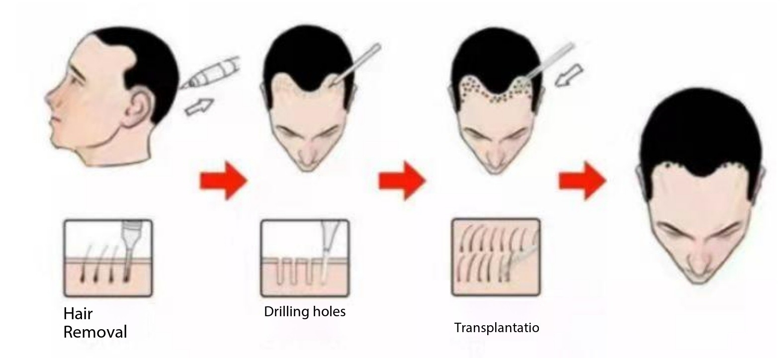 Technological Innovation in Hair Transplant Devices
