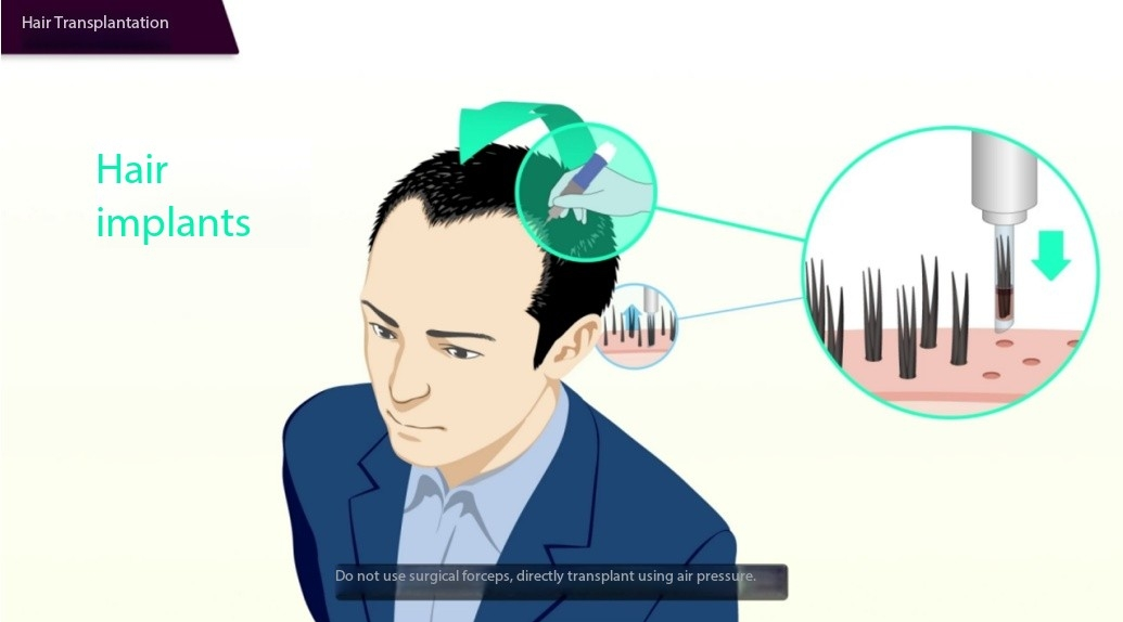 Technological Innovation in Hair Transplant Devices