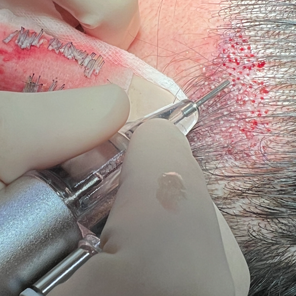 Technological Innovation in Hair Transplant Devices