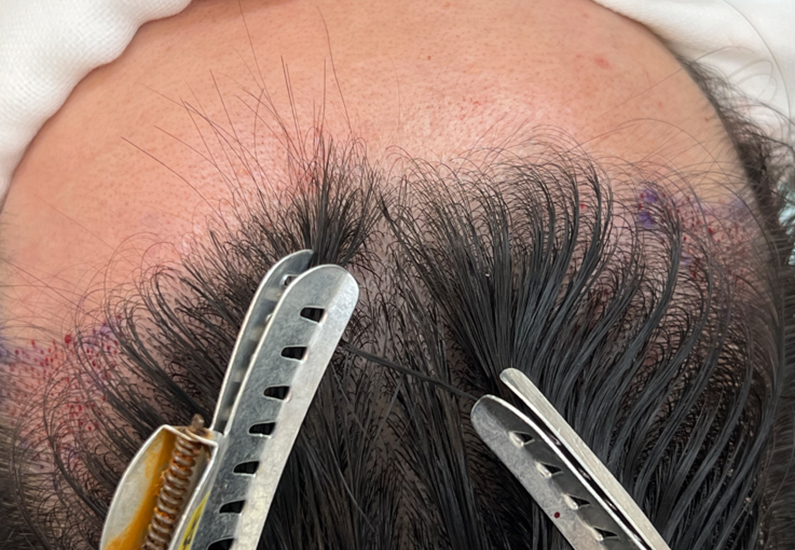 Innovative Air and Fluid System Design for Modern Hair Transplant Devices
