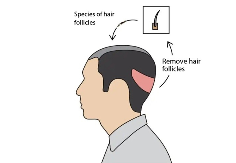 Personalized hair transplant aesthetic system