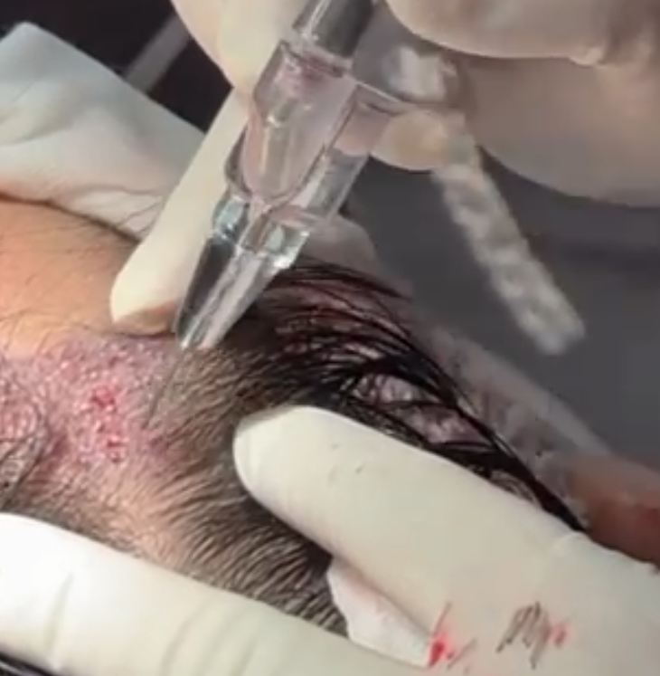 FUE Implantation Device FUE Implantation Device