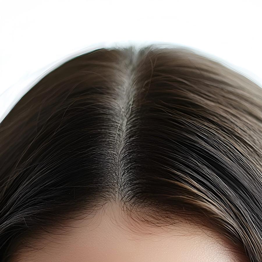 Treating Wide Hair Parting in a Singaporean Woman with FUE