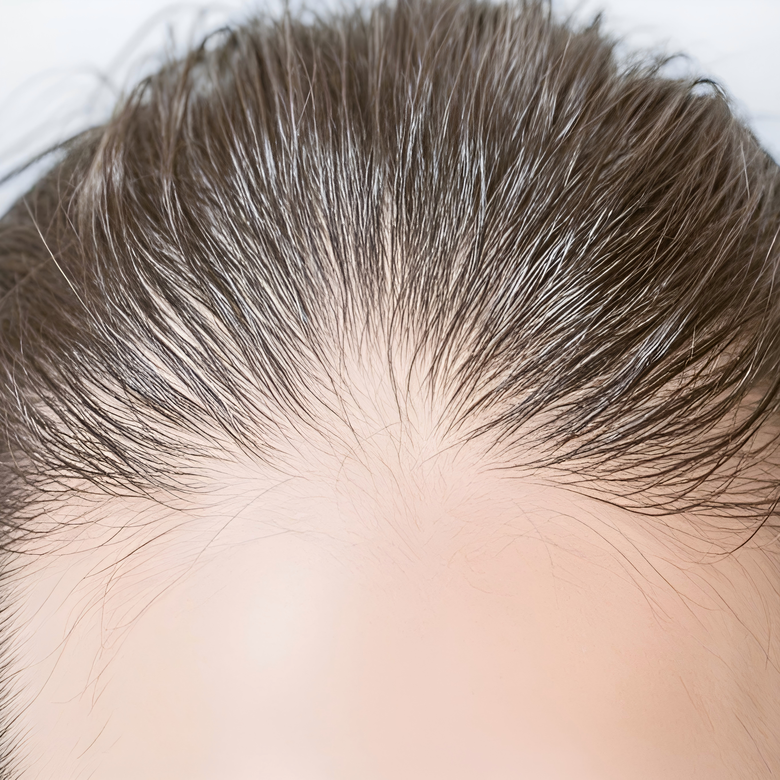 Restoring Hair Density for an East Asian Woman with FUE+ Technology