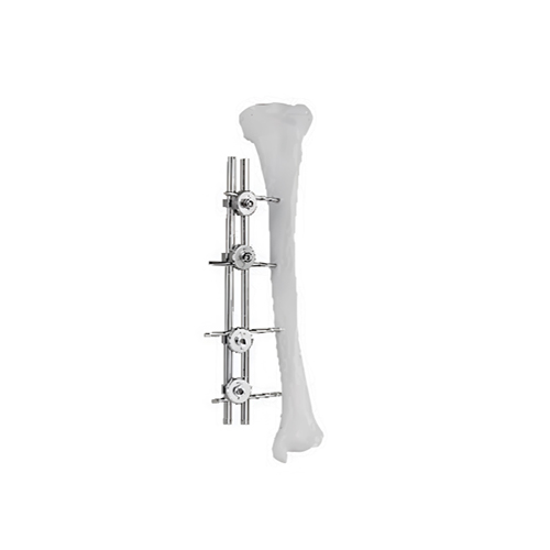 Single-Sided External Fixator System Orthopedic Trauma