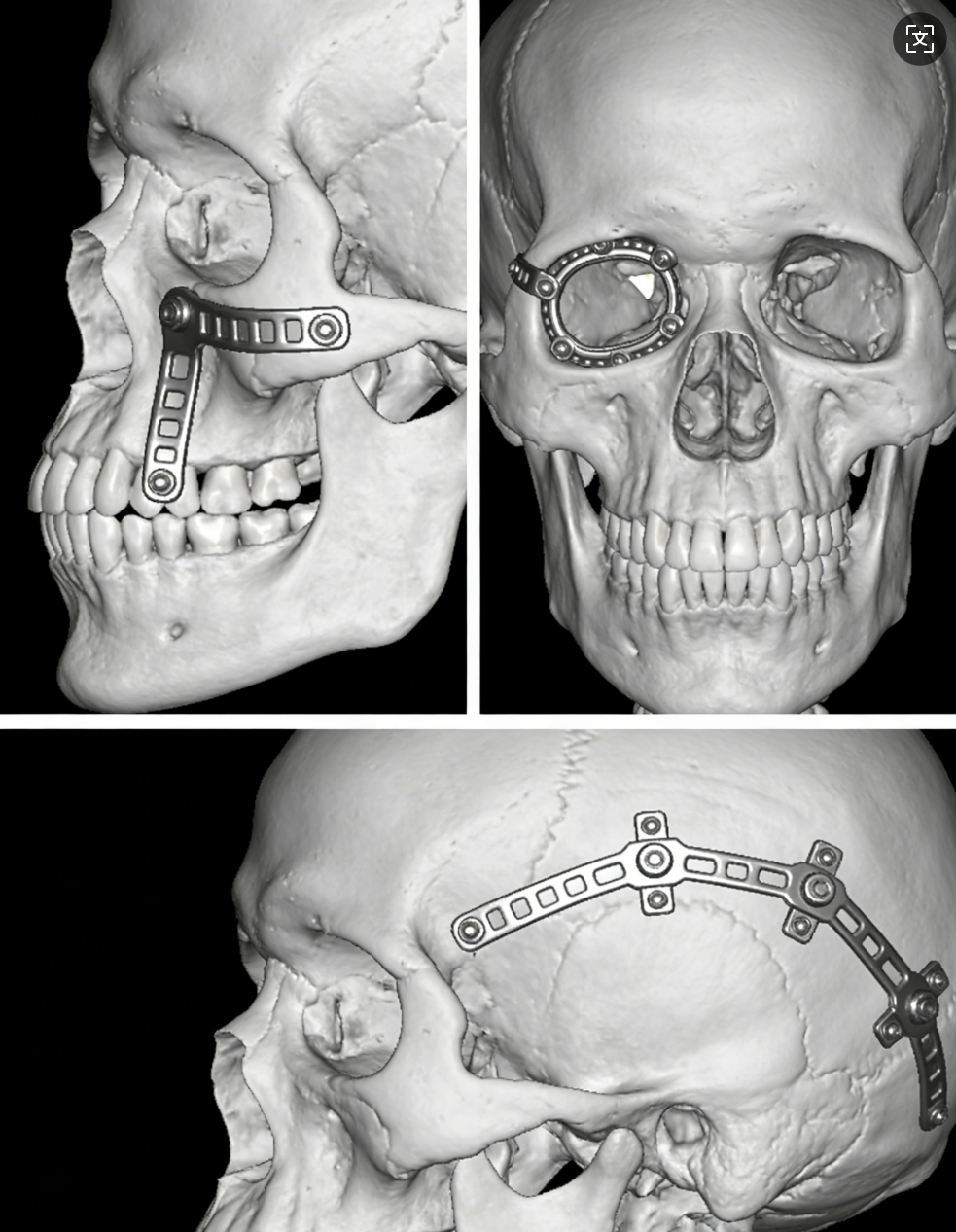 Three Key Implants for Craniofacial Reconstruction Surgery