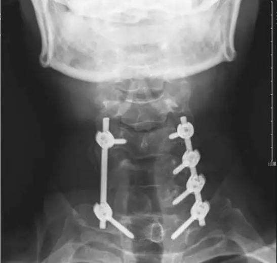 lumbar cage fusion posterior