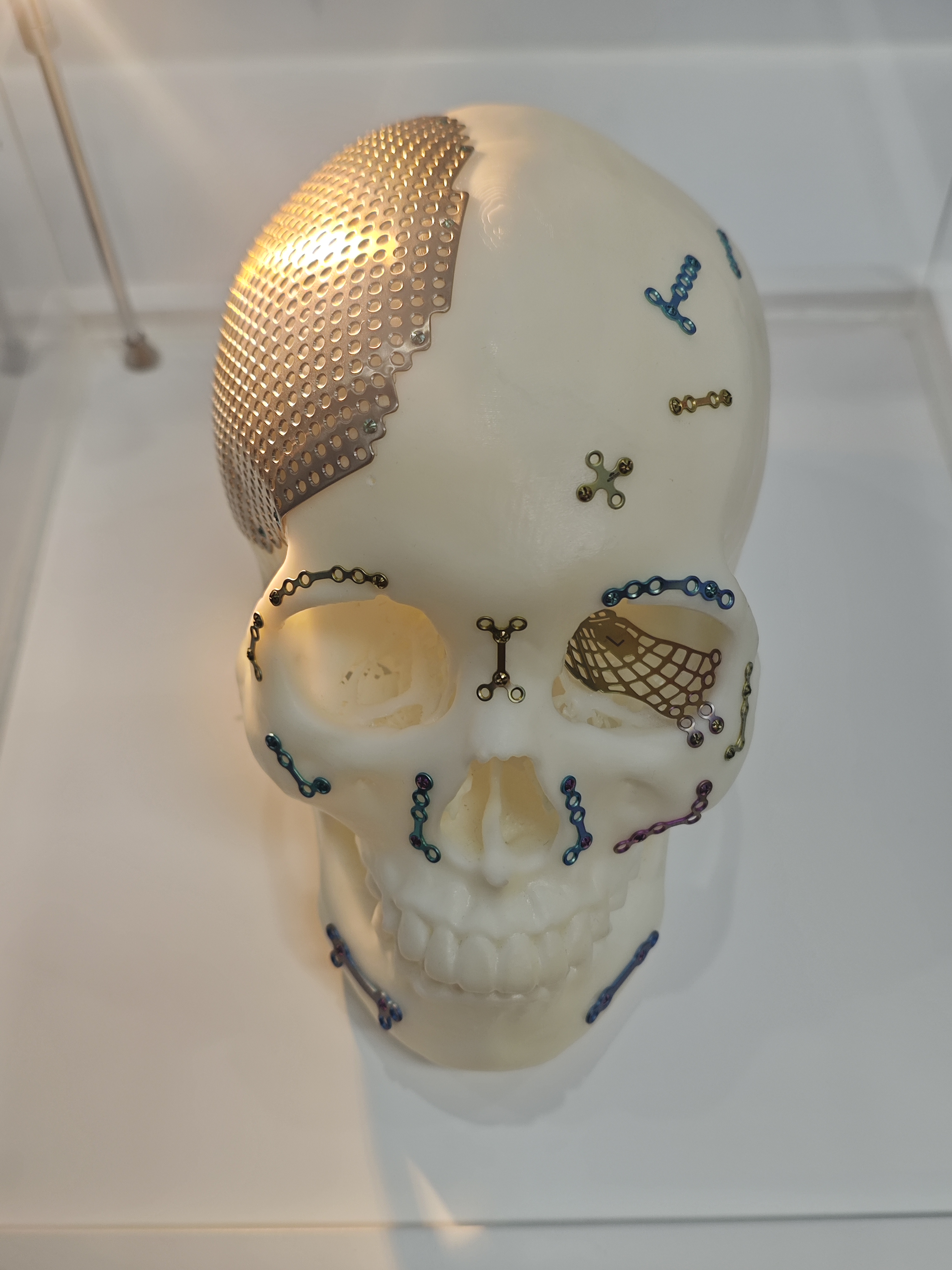 How Do Zygomatic, Orbital, and Cranial Plates Reconstruct the Face?