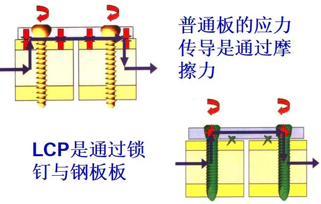 How Do Dynamic Compression Plates and Cortical Screws Work Together?