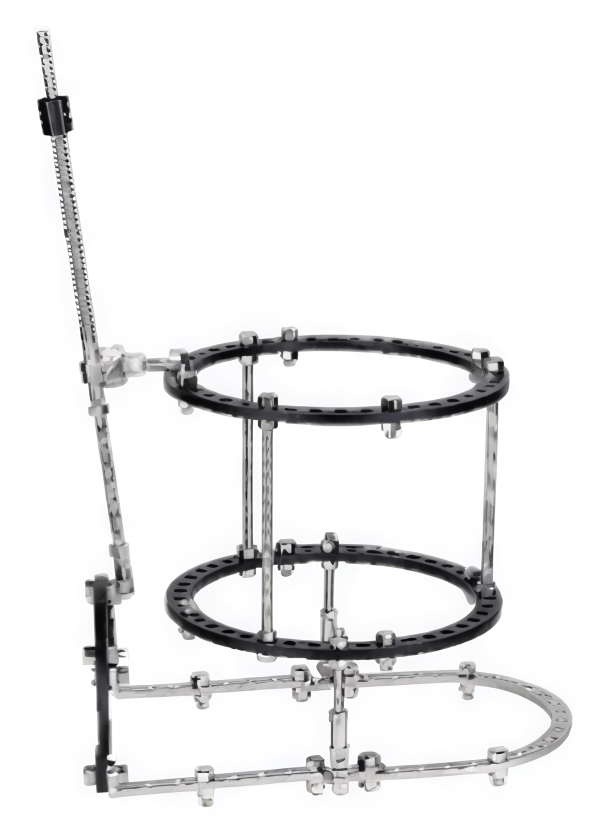 Bone Lengtheningilizarov External Ring Fixator