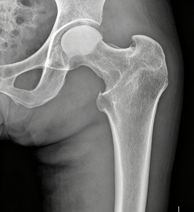 dynamic hip screw dynamic hip screw