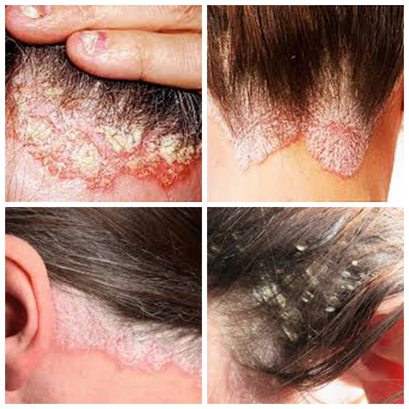 light therapy for scalp psoriasis