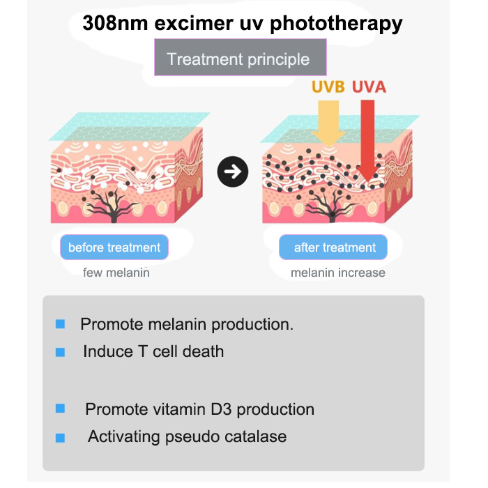 308nm Excimer Laser