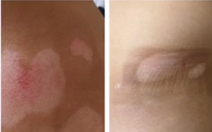 308nm excimer laser for vitiligo