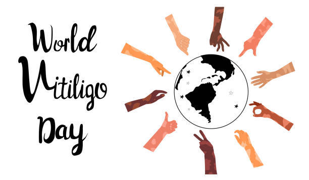 11. Dünya Vitiligo Günü'nün refah etkinliği yakında geliyor