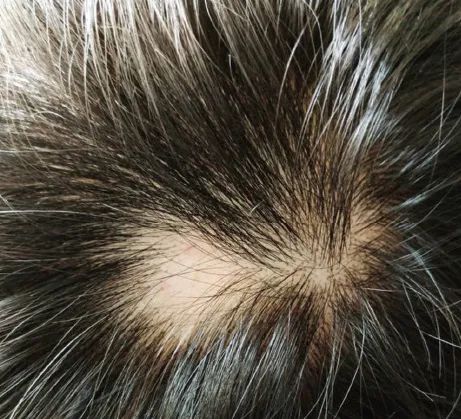 low level laser therapy for hair loss