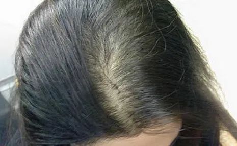 hair loss therapy