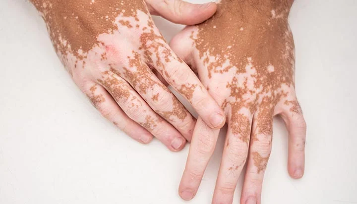 What is vitiligo?