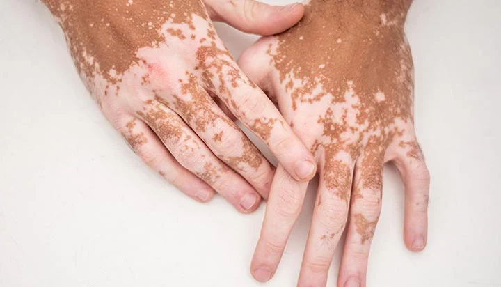 Was ist Vitiligo?