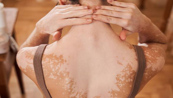 9 coisas que o vitiligo mais odeia