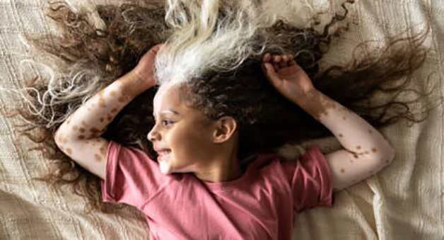 Behandlung von Vitiligo bei Kindern: Ihr ultimativer Ratgeber!