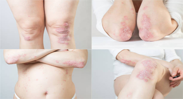 Avanços no tratamento da psoríase: combinação de fototerapia e medicamentos