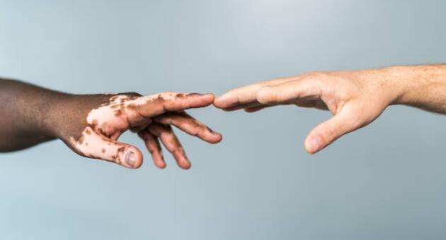 ما الذي يجب أن نعرفه عندما نصاب بالبهاق في اليدين؟