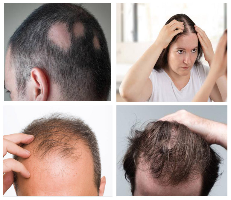 Hair Loss and treatment