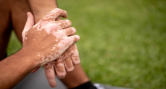İlkbaharın Temelleri: Vitiligolu Arkadaşlar İçin Günlük Yaşam İpuçları
